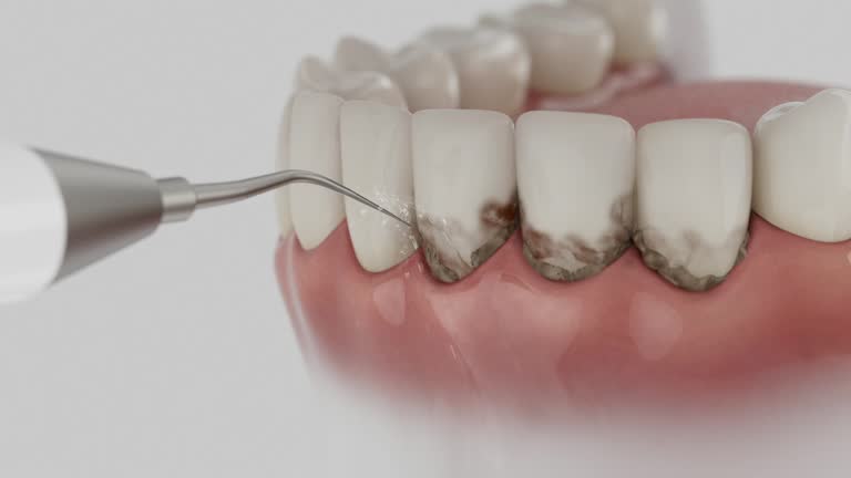 Trusted Wisdom Tooth Removal service in Lely Resort, FL - Dentist Open Now